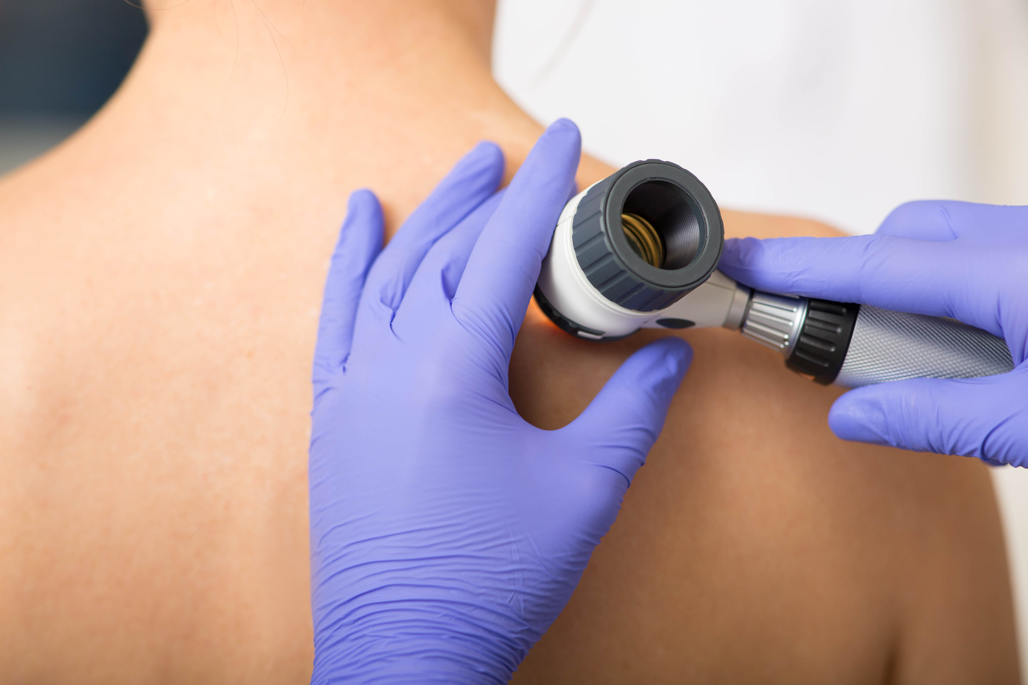 Deucravacitinib, Tapinarof, Roflumilast, Spesolimab : psoriasis treatment - dermatology