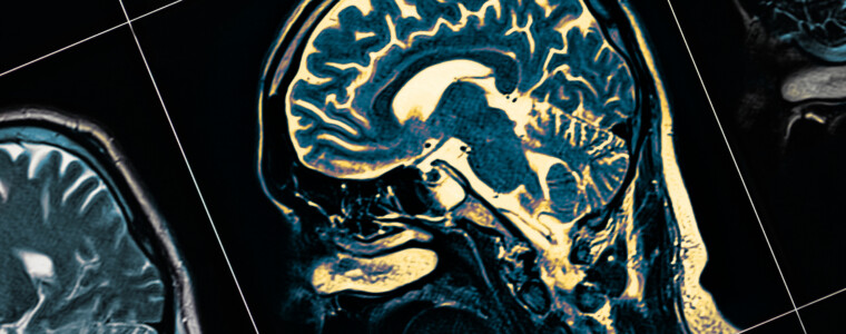 A new study shows that a loss of visual sensitivity can predict dementia up to 12 years before diagnosis. Learn more about dementia and how a visual sensitivity test can assist with early detection.