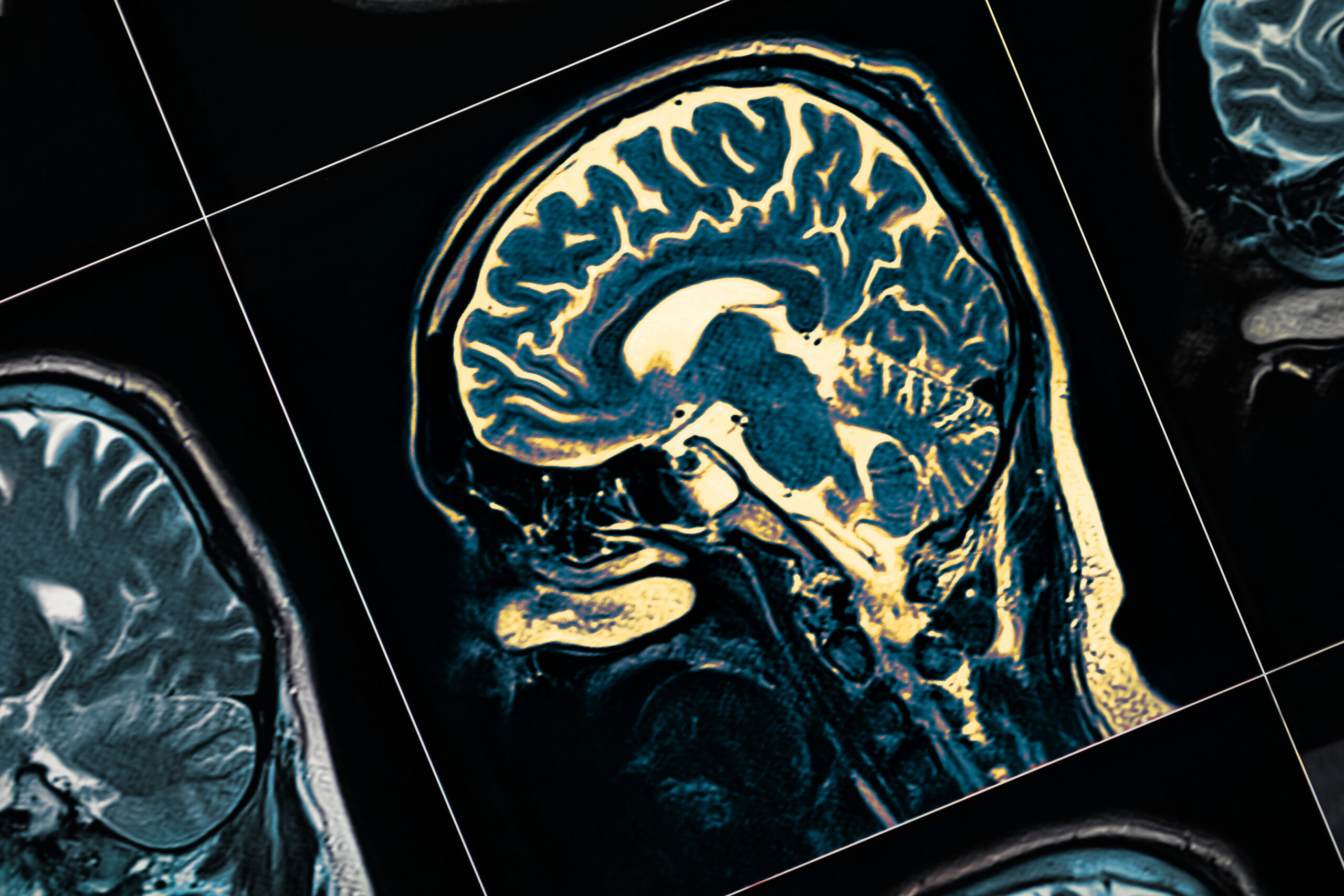 A new study shows that a loss of visual sensitivity can predict dementia up to 12 years before diagnosis. Learn more about dementia and how a visual sensitivity test can assist with early detection.