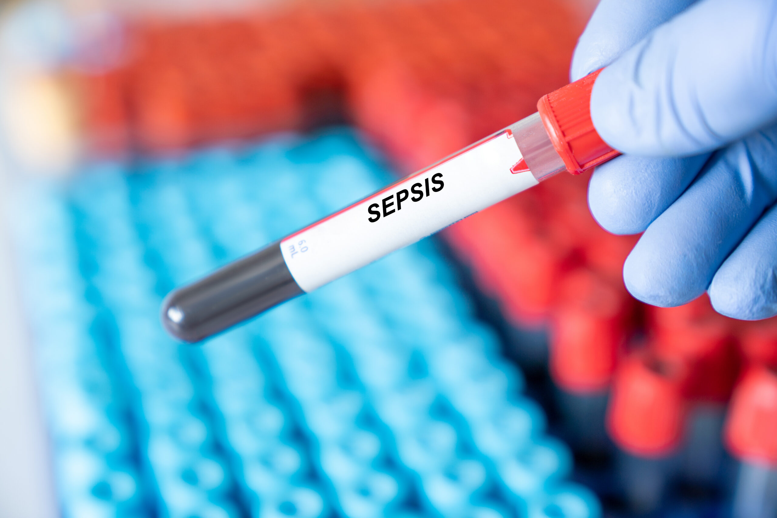 Redox Biology study identifies PP4 protein in sepsis, helping control sepsis overreaction and guiding new treatments for sepsis.