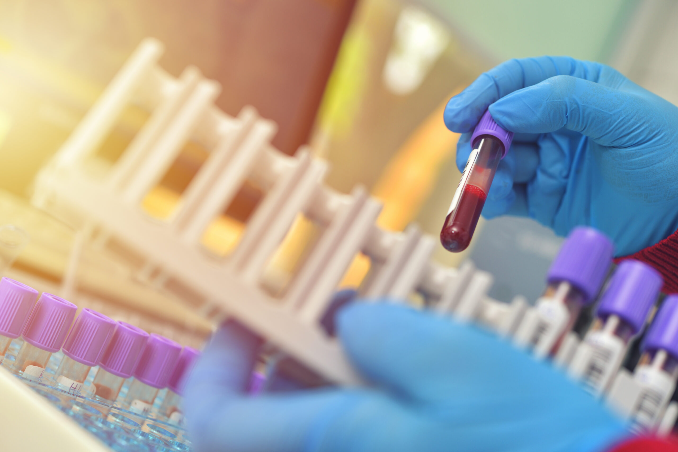 Blood test predicts alzheimer’s years early using plasma phosphorylated tau 217, with breakthrough findings from Mass General Brigham.