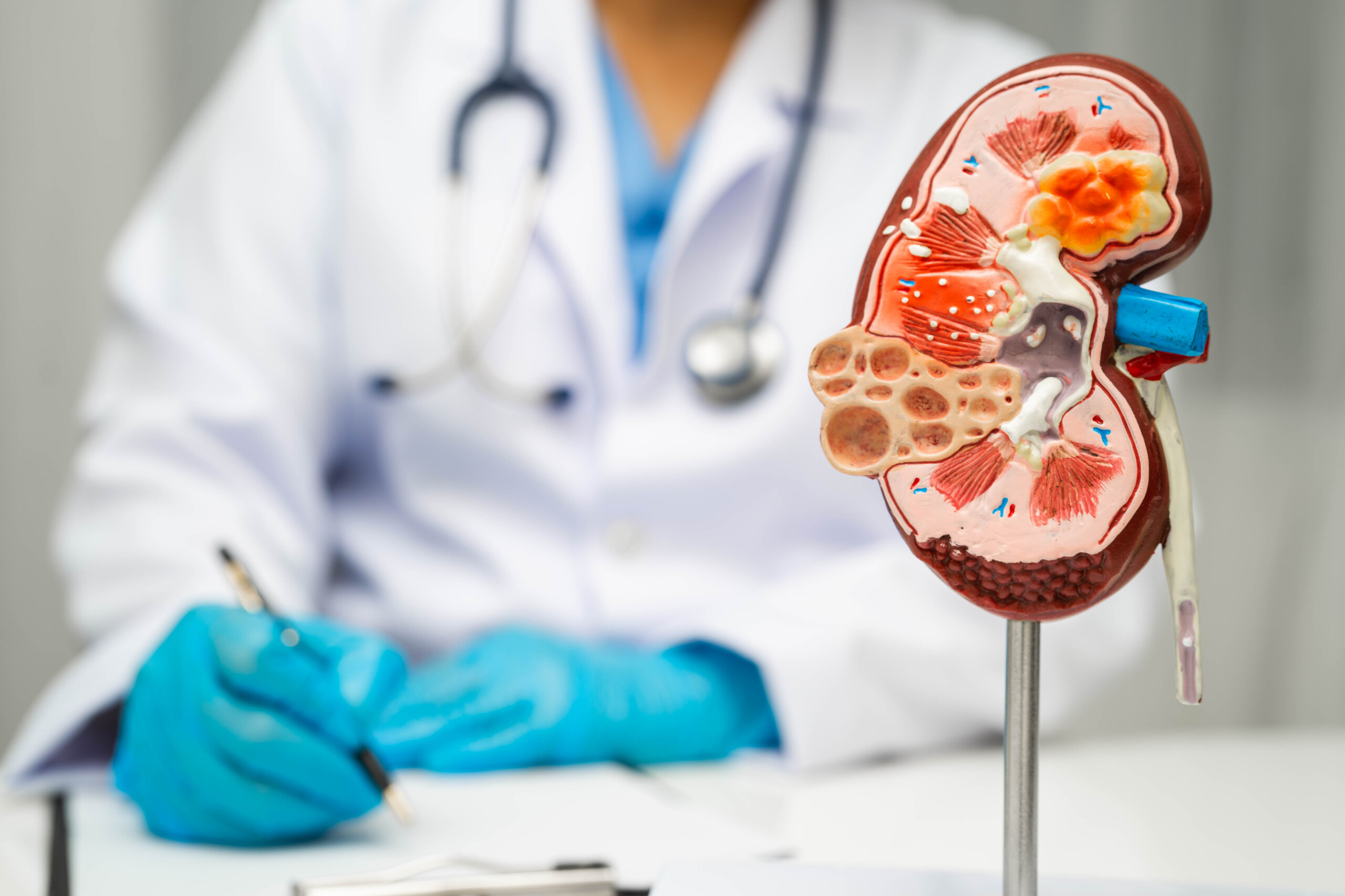Stage 2 chronic kidney disease is often missed, with a reduced estimated glomerular filtration rate still within the kidney function threshold.