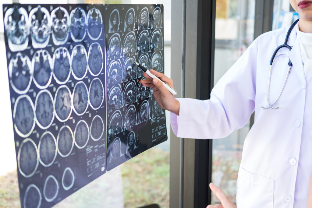 Learn stroke warning signs from Mayo Clinic neurologists and reduce risk through managing modifiable risk factors before stroke strikes.