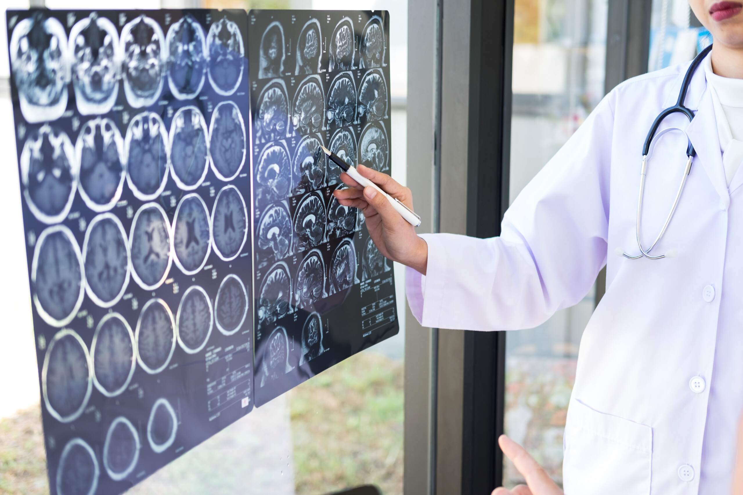 Learn stroke warning signs from Mayo Clinic neurologists and reduce risk through managing modifiable risk factors before stroke strikes.