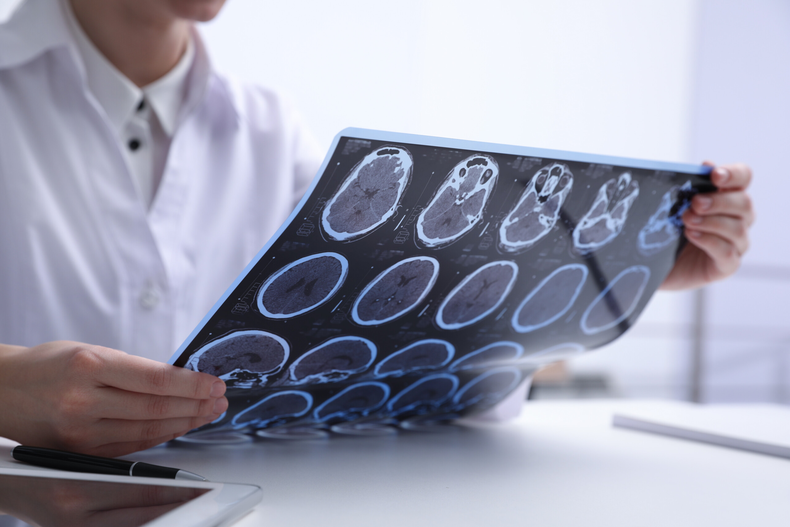 Epstein-barr virus (ebv) reactivation may precede multiple sclerosis (ms) relapse by up to three months in people with certain genetic risk factors.